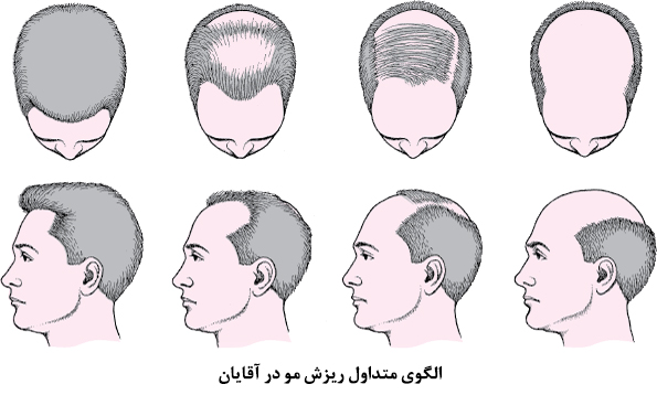 الگوی ریزش مو آقایان