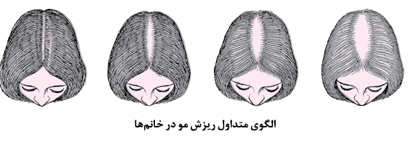 الگوی ریزش مو خانم ها