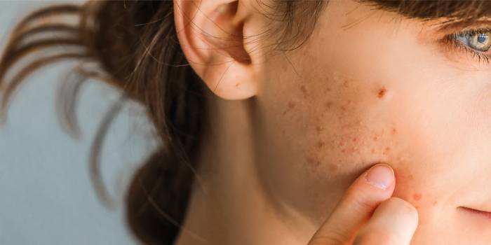 راه های درمان فوری جوش صورت