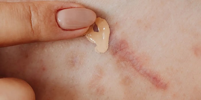پوشاندن جای زخم با آرایش