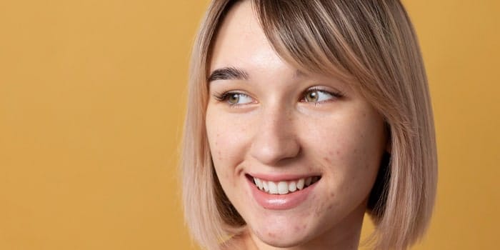 نحوه درمان جوش چانه