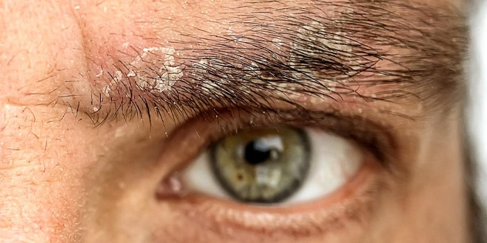 درمان شوره ابرو