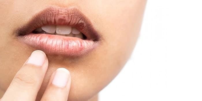 درمان تیرگی لب