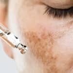 ملاسما پوست چیست و چگونه رفع می شود؟